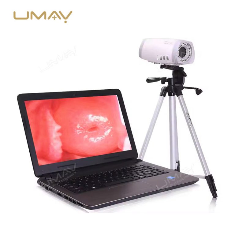 Convenient Handheld Digital Video Colposcope with Laptop for Gynecological Diagnostics