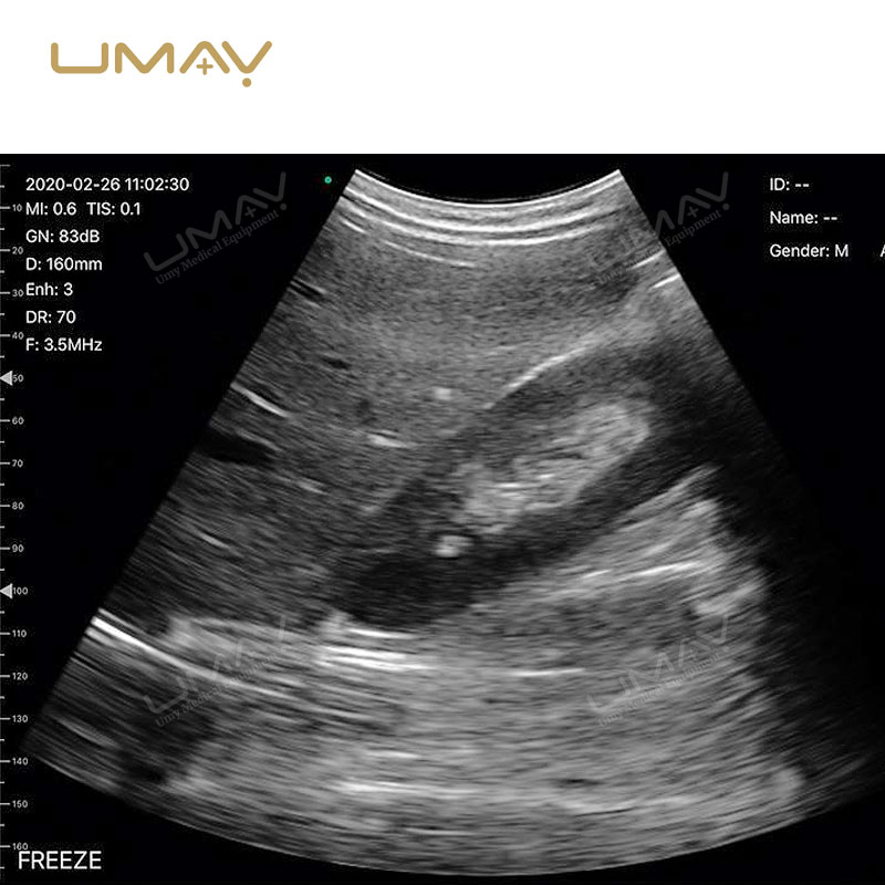 Wireless Ultrasound Probe with 128 Elements and Convex Scanner for Ultimate Clarity Imaging