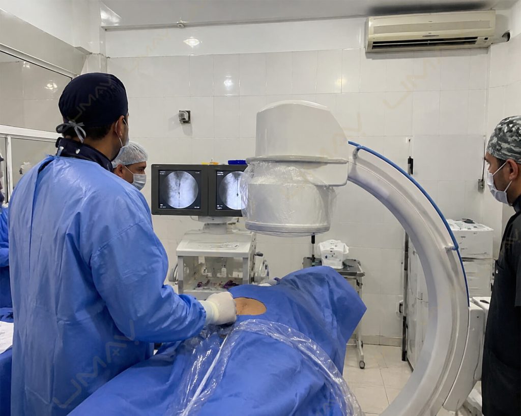 Intraoperative Mobile C-Arm Fluoroscopy System in Surgical Room A surgical team in sterile gowns and scrubs operates a mobile C-arm fluoroscopy system over a patient during an intraoperative procedure, with dual monitors displaying real-time X-ray images in the background.