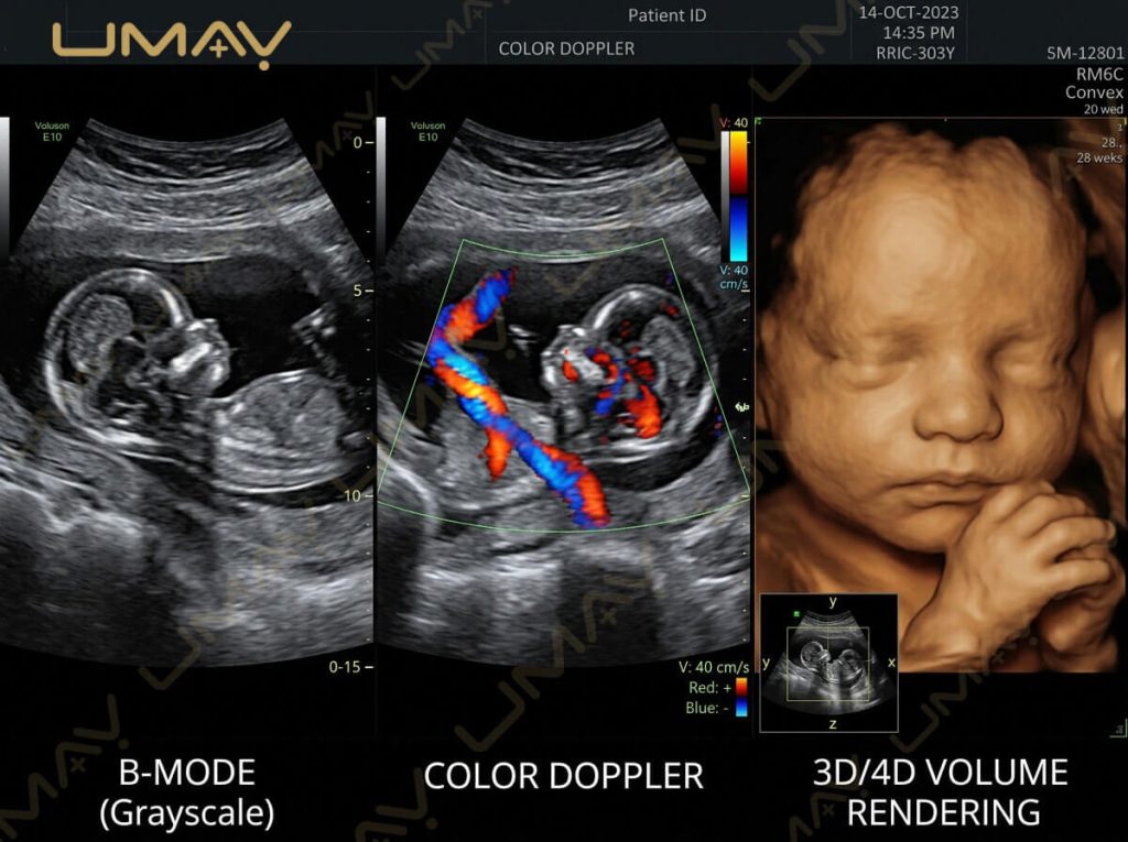 Fetal ultrasound comparison showing B-mode grayscale, Color Doppler umbilical blood flow, and 3D/4D volume rendering.